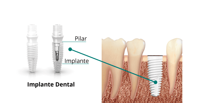 proceso para poner un implante dental