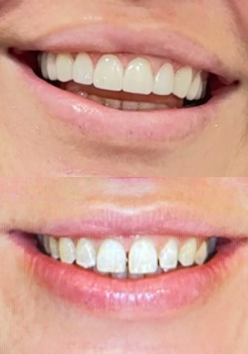 Implantes dentales antes y despues dental spa clinics