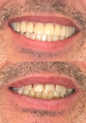 Implantes dentales antes y despues dental spa clinics barcelona