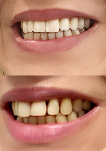 Implantes dentales antes y despues dental spa clinics