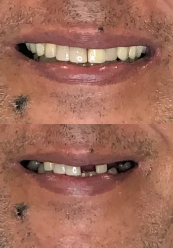 Implantes dentales antes y despues dental spa clinics