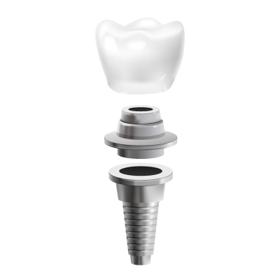 Dental Implants