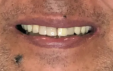 lp-implantes-bar-10