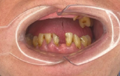 antes y despues implantes dentales-14