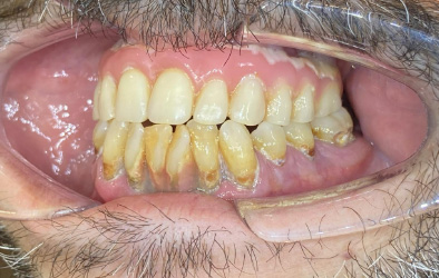 antes y despues implantes dentales-14