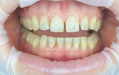 antes y despues implantes dentales-14