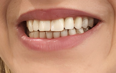 carillas dentales