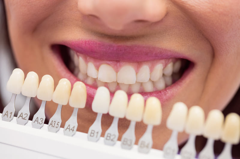 Carillas dentales, qué son, cuándo sí y cuándo no